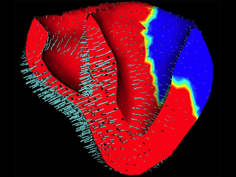 L'Inria Sophia et ExactCure en pointe dans le programme européen SimCardioTest